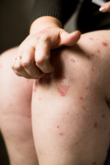 The problem with many people - eczema or psoriasis on hand skin. Woman itchind dry skin on legs. Ill allergic rash