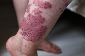 Allergic rash dermatitis eczema skin on leg of patient. Psoriasis and eczema skin with big red spots