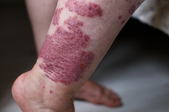 Allergic Rash Dermatitis Eczema Skin On Leg Of Patient. Psoriasis And Eczema Skin With Big Red Spots