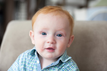 Ginger boy with allergies (atopic dermatiti on his face)