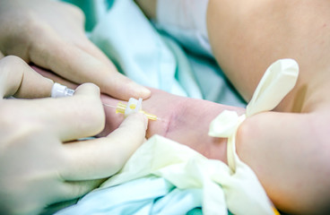 Setting the peripheral catheter to the patient before surgery.