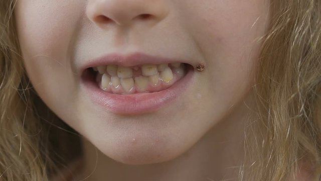 Small kid smiling and showing gums and teeth with dental caries, yellow spots