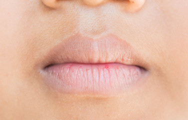 Obraz premium Dry lips and peeling