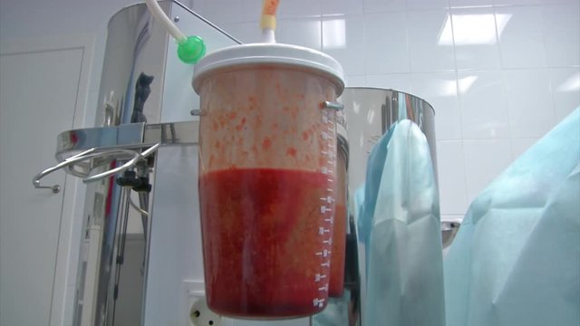 Partial removal of fat and mucous tissues. Fat liquid in the bottle from liposuction