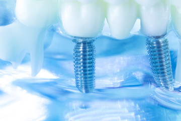 Dental titanium tooth implant