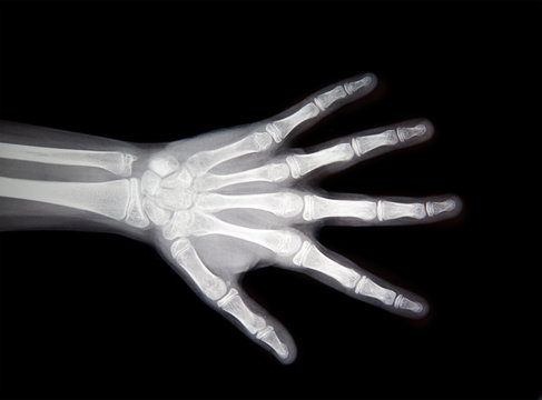 X-ray of hand