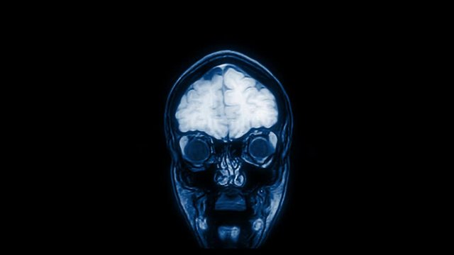 Computed medical tomography MRI upscaled scan of healthy young female head. Front view. Discrete slices. Blue/teal on black background.
