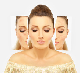 Post-Acne Marks /Treating Acne Scars