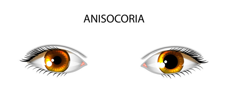 Anisocoria. Pupils Of Different Sizes