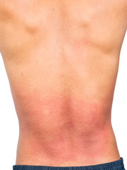 Skin allergy on back of man