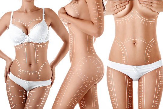 Female body with patterned lines and arrows on it, isolated on white. The concept of plastic surgery, fat removal, liposuction and cellulite.