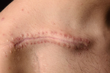 detail of a scar on the clavicle