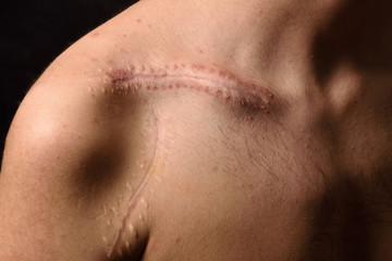 detail of a scar on the clavicle - obrazy, fototapety, plakaty