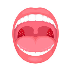  vector illustration of a throat bacterial and viral infection, tonsils inflammation.