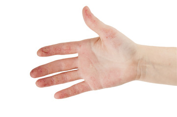 Female hand with dermatitis