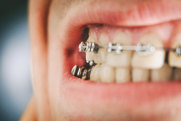 Braces and dental appliance for deep bite