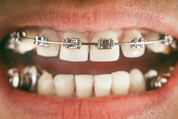 Braces and dental appliance for deep bite