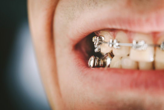 Dental appliance for deep bite