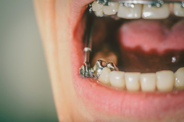 Dental appliance for deep bite