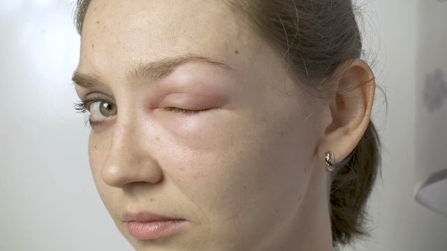 Woman with allergy touching eye