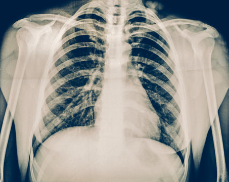 X-ray of a human chest or lungs radiography shot, medical technology and roentgen clinic diagnostic concept