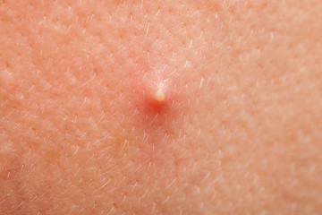 Fototapeta premium The inflamed facial acne, close up.