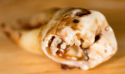 Caries on the teeth of a man