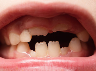 baby mouth with teeth