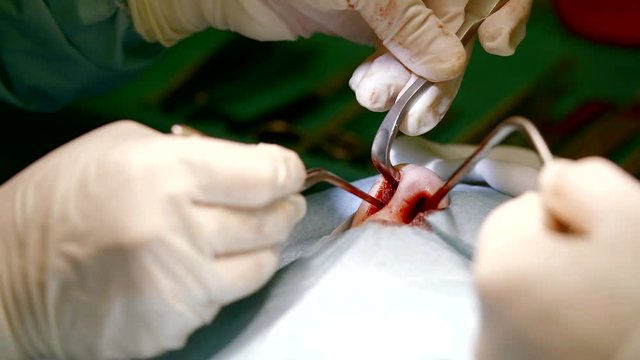 doctors are correcting nasal shape of human, inputting sterile instruments in a cavity and cutting, close -up