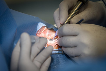 Zagreb, Croatia - June 12, 2017: Eye surgery in the hospital, eye and diopter correction. In the operation of the gray star, the torn lens is surgically replaced by an artificial lens implant