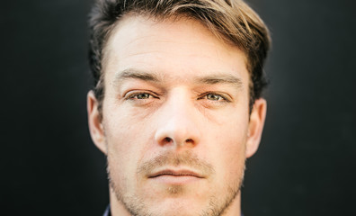 Fototapeta premium Allergic Reaction or Eczema around the Eyes of a Young Adult