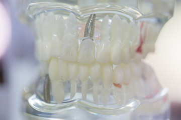 Fototapeta na wymiar Dental implants, training models