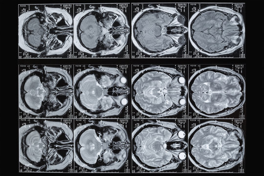 Photo MRI ,MRA,of the brain