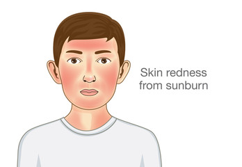 Skin redness appear on facial and neck of kid from sunburn. Illustration about danger of Ultraviolet radiation.