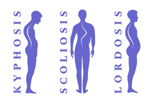 Diseases of the spine. Scoliosis, lordosis, kyphosis. Body posture defect. Human silhouettes isolated on white. Vector illustration.