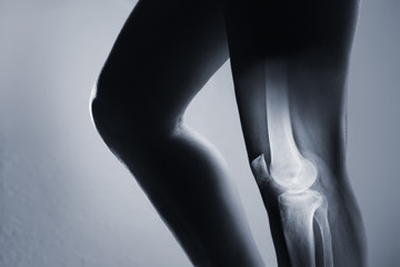 Human knee joint and leg in x-ray
