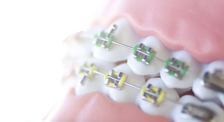 Cosmetic dental metal brackets