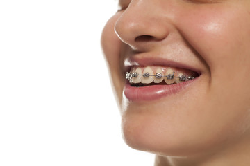 a smiling young woman with a dental prosthesis