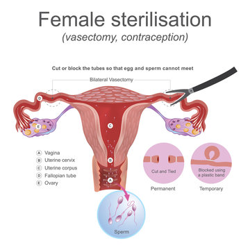 Female sterilisation vasectomy. The male reproductive system these work together to produce sperm.