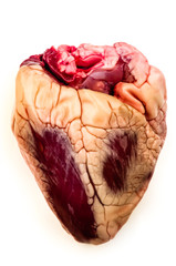 Heart coated with a layer of fat caused by high cholesterol lipid lipids damage