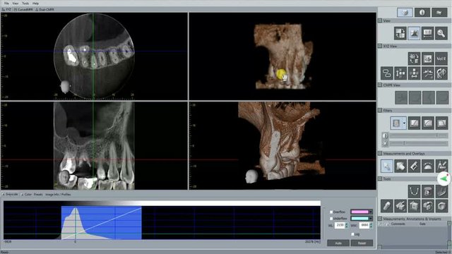Doctor checking 3D dental scan for implant