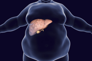 Obese man with fatty liver, 3D illustration. Conceptual image for non-alcoholic fatty liver disease - obrazy, fototapety, plakaty
