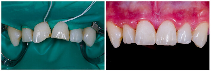 Aesthetic and function with direct composite
