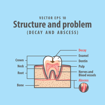 Decay and abscess cross-section structure inside tooth diagram and chart illustration vector on blue background. Dental concept.