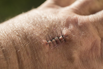 Stitches on hand