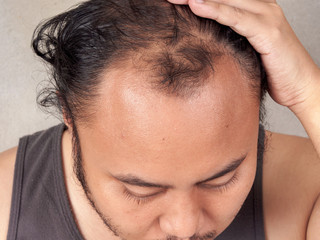 Fototapeta premium closeup of hair lose