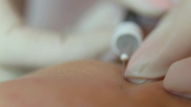 intradermal injections for rejuvenation, closeup