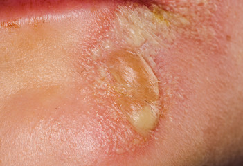 Fototapeta premium blisters on the skin of the face