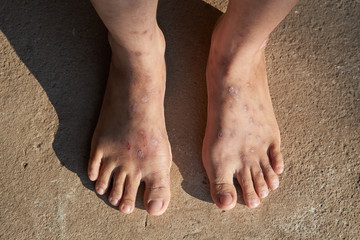 Fototapeta na wymiar a lot of scars on woman feet.