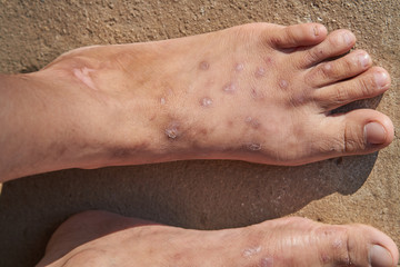 a lot of scars on woman feet.